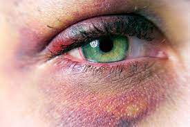 2 Most Common Eye Injuries And Management