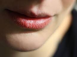 3 Major Health causes of lips dryness and cure