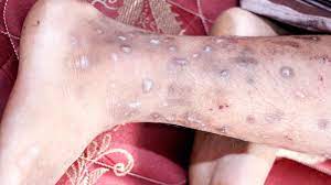 3 most infectious skin infections and treatments