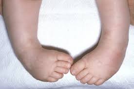 Why clubfoot in kids, 3 major causes and management